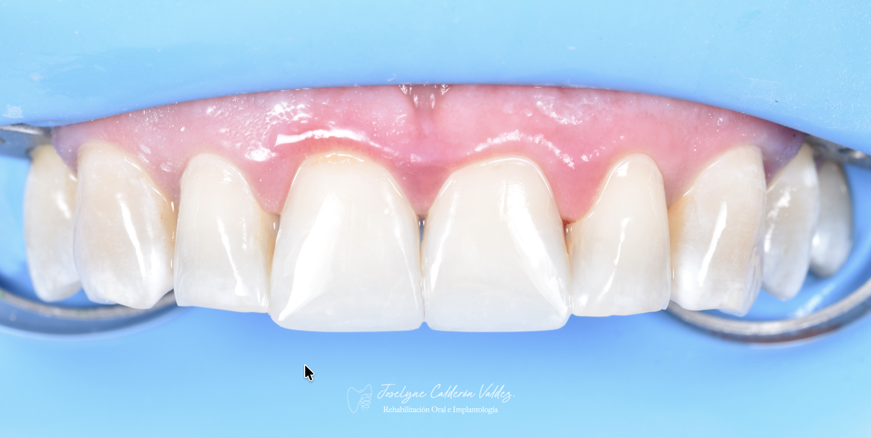 Restauración estética anterior después de tratamiento