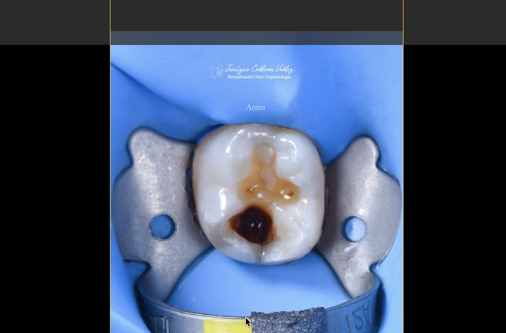 Aislamiento para restauración dental