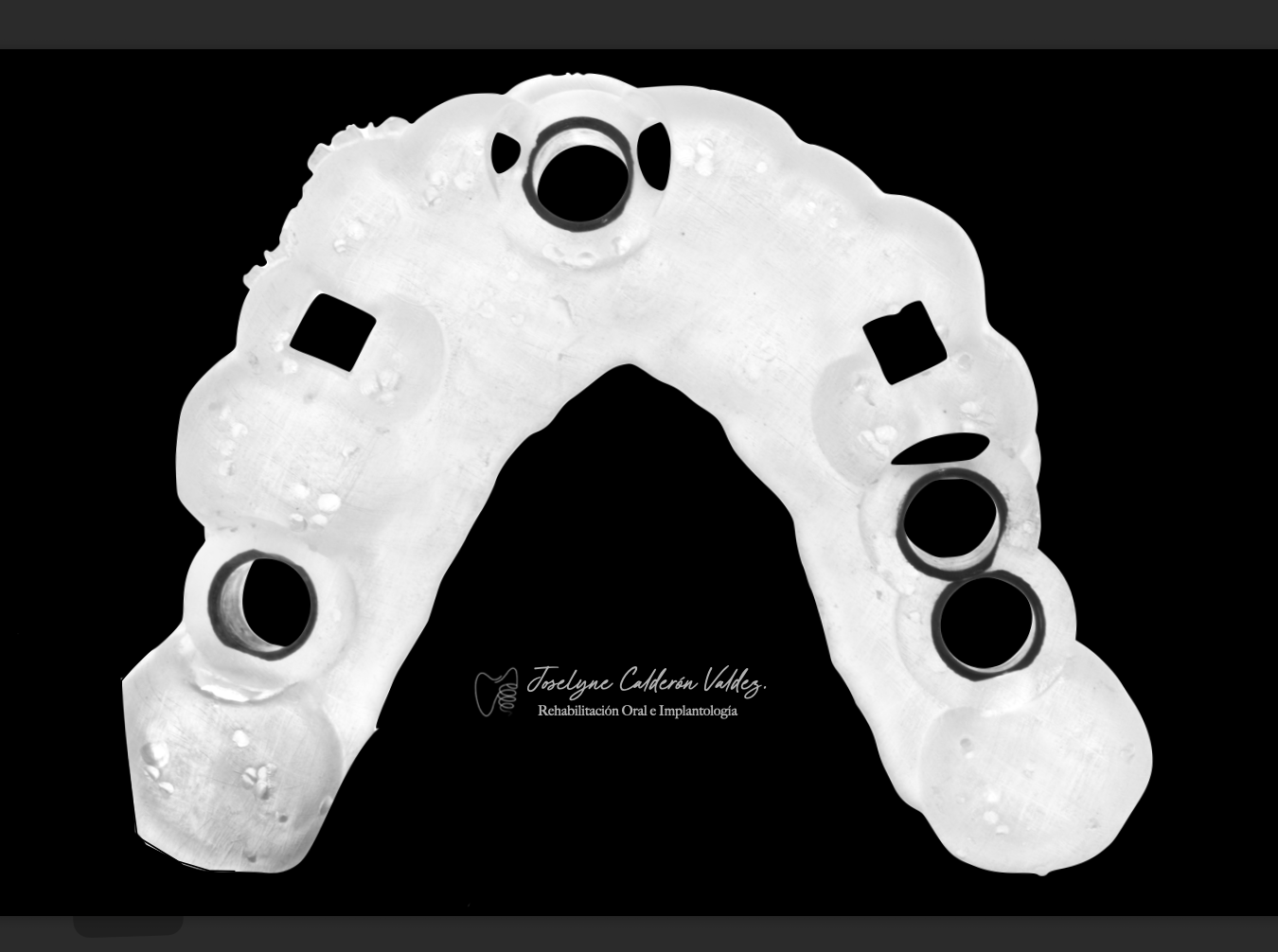 Guía para cirugía de implantes dentales