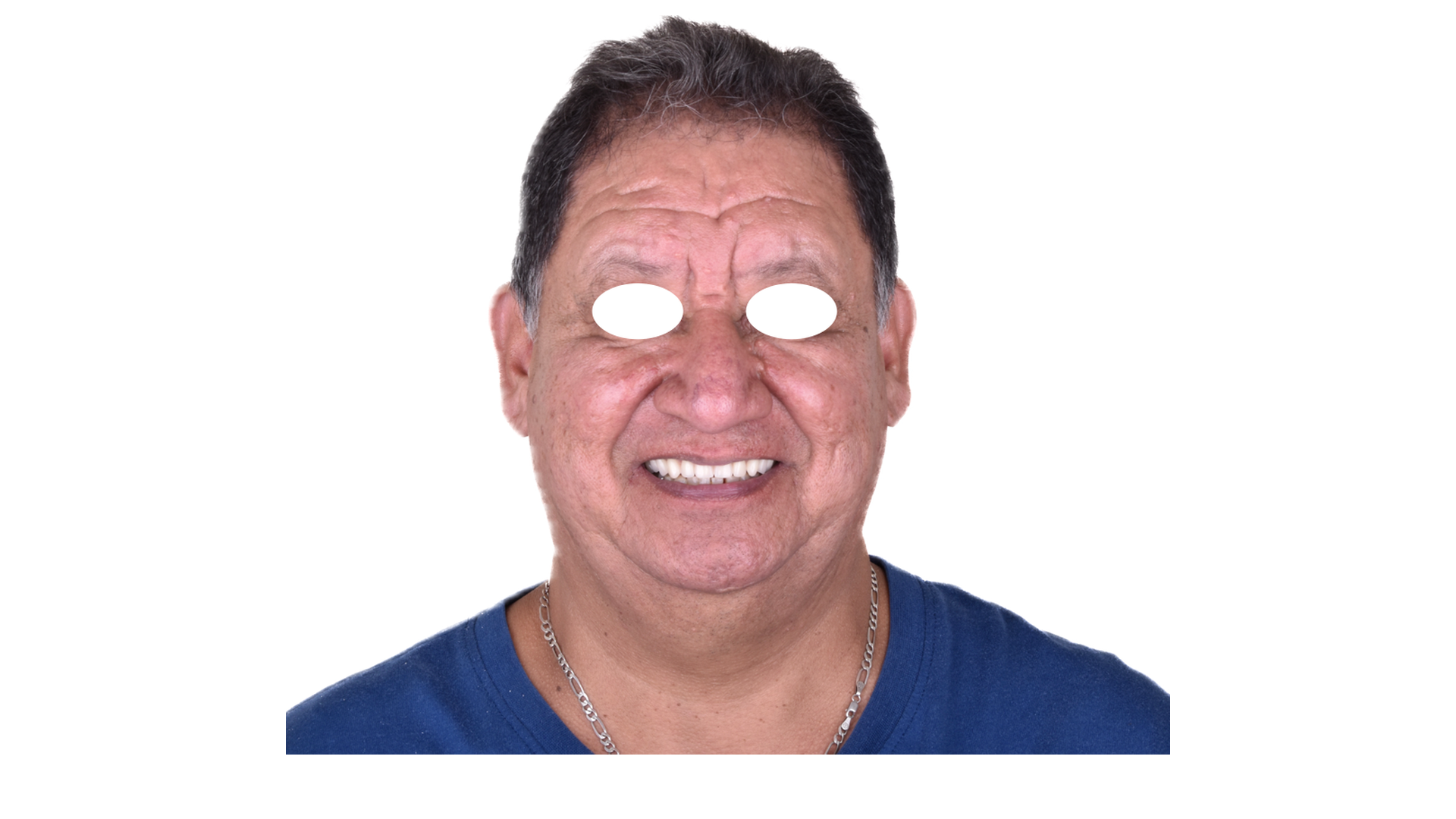 Después de restauración dental