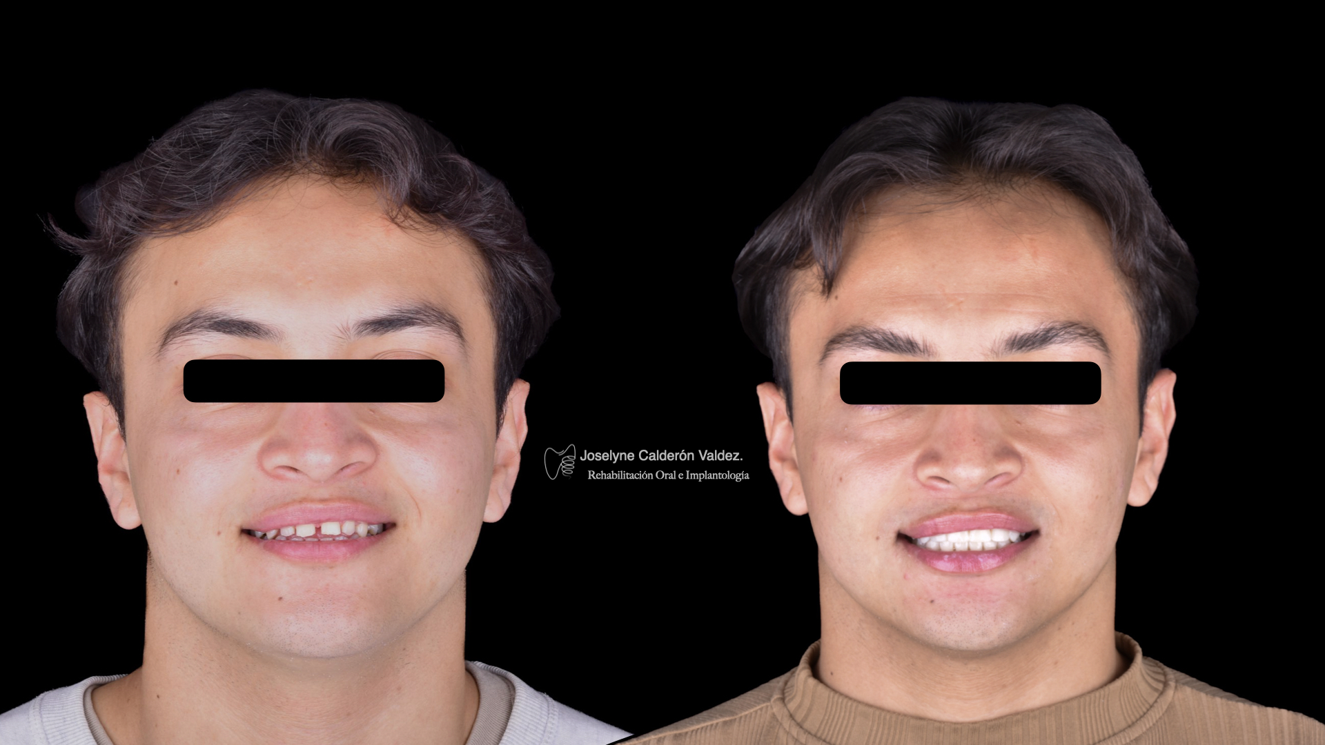Caso clínico de diseño de sonrisa antes y después
